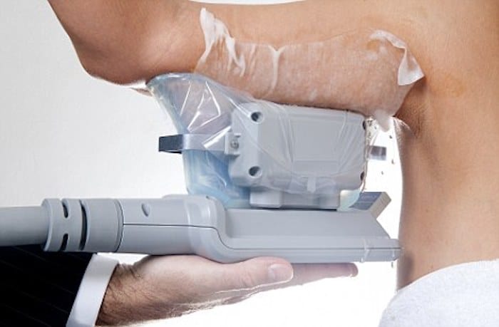 fat freezing arms Sidcup