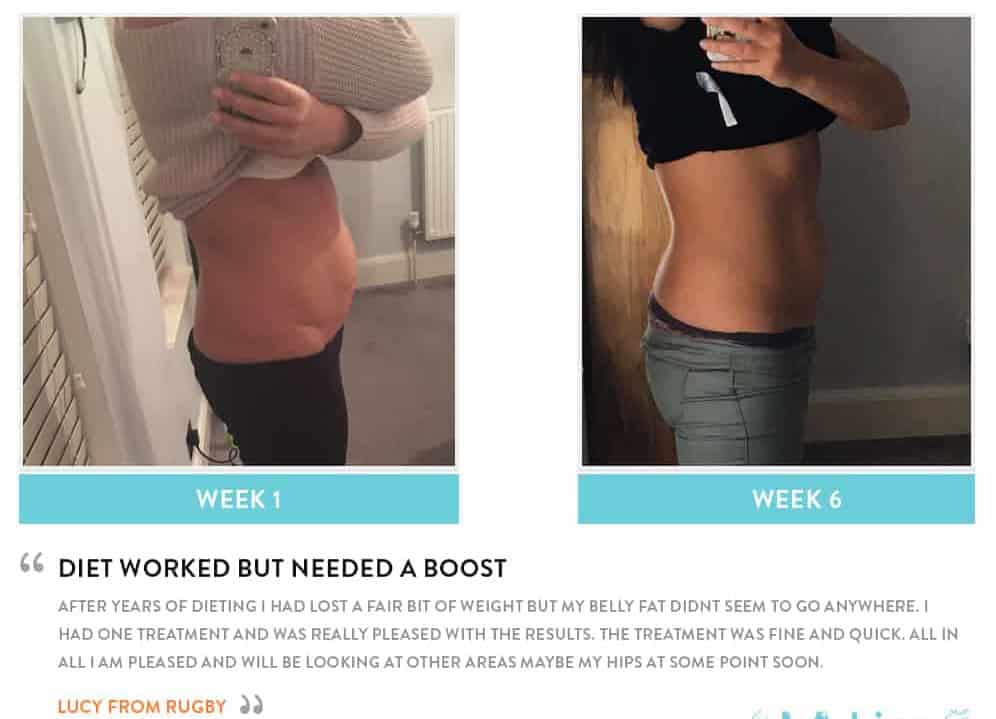 Before and After Dieting Sidcup