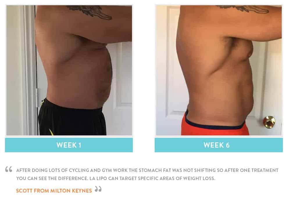 Before & After Stomach Fat Sidcup