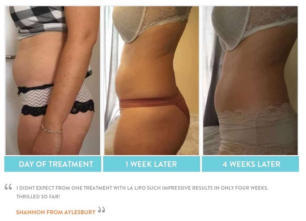 before, Cryolipolysis Sidcup