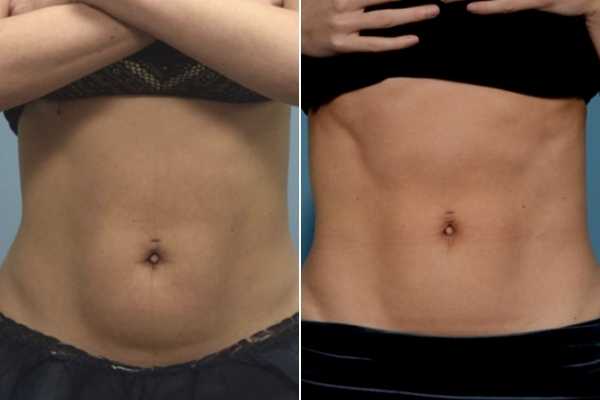 body sculpting FAQs Sidcup