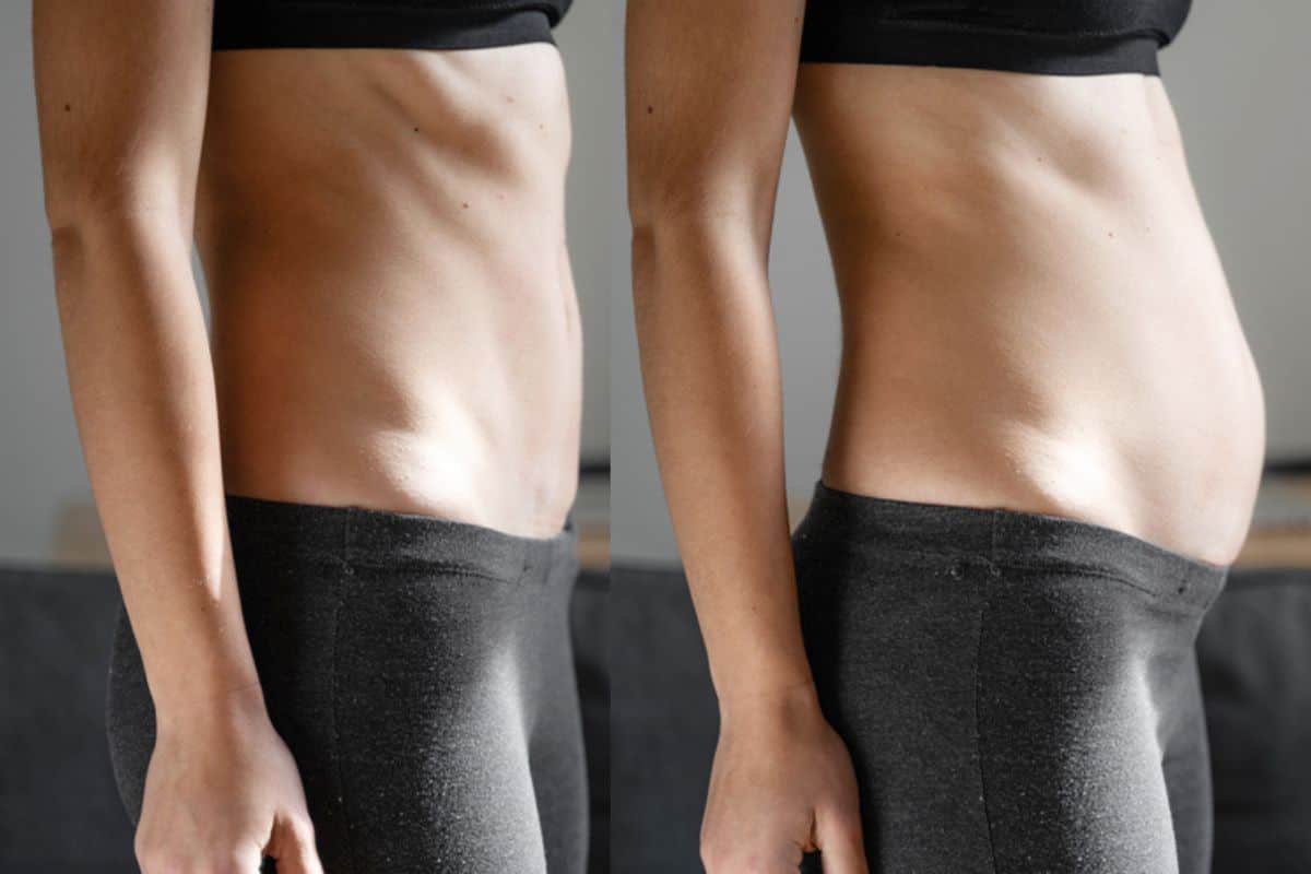 How long does diastasis recti take to improve Sidcup?