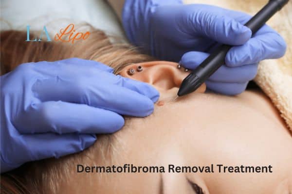 Dermatofibroma Removal Treatment Sidcup