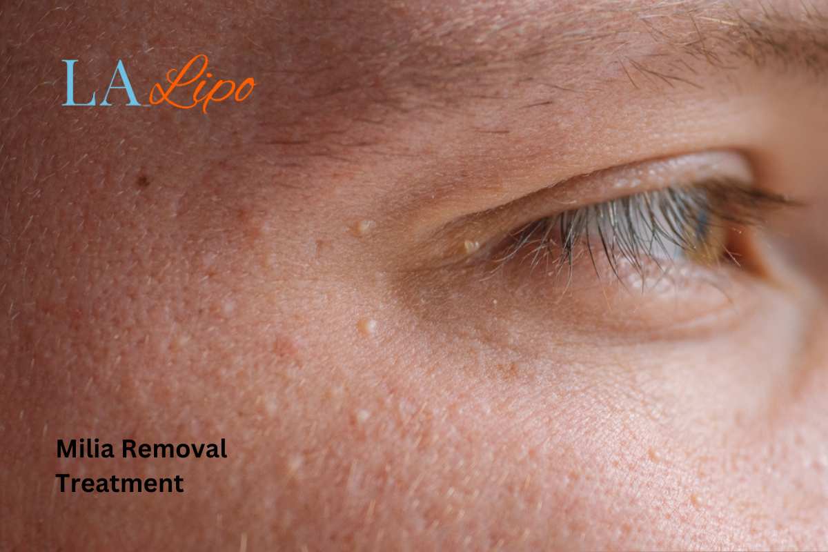 Cryopen Milia Removal: Is It the Easiest and Safest Option Sidcup?