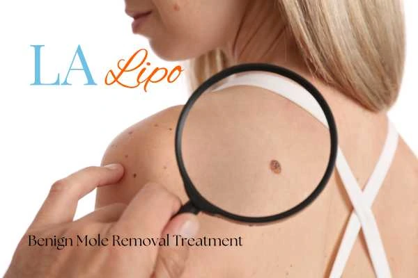Why getting moles removed Sidcup can boost your confidence!