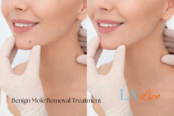 Woman's before and after results of being moles removal treatment Sidcup