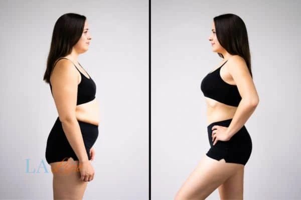 image of woman before and after results of LA-EMS Body Sculpting Sidcup to help treat Diastasis recti