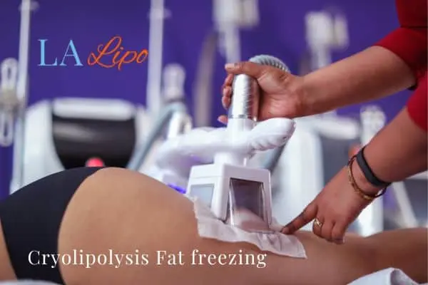women getting fat freezing Sidcup