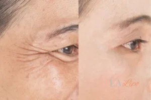 Before and after results of woman - HI-fu wrinkles reduction treatment Sidcup
