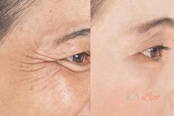 Before and after results of woman - HI-fu wrinkles reduction treatment Sidcup
