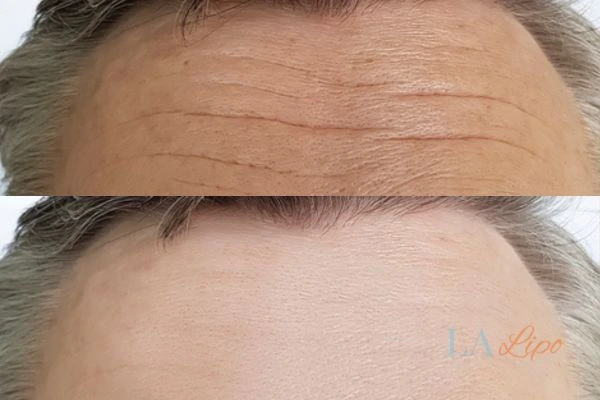 results of HIFU Sidcup on mans forehead to help reduce lines and wrinkles