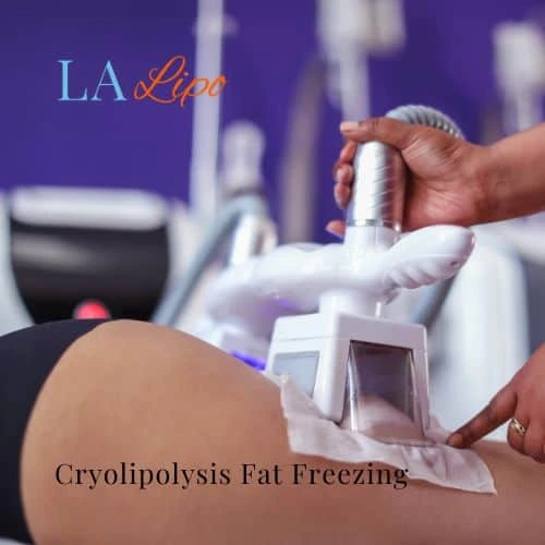 fat freezing - Cryolipolysis Sidcup