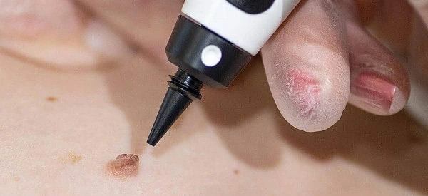 skin tag removal using cryopen Sidcup