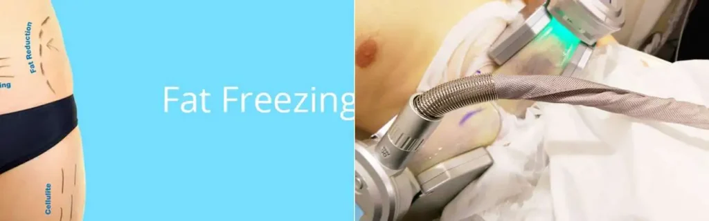 Fat freezing Sidcup on multiple areas of the body