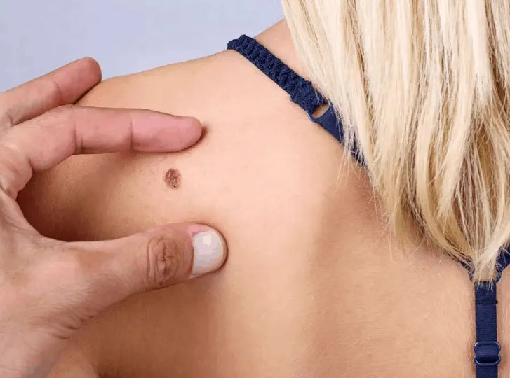 woman having mole removal Sidcup consultation before treatment.