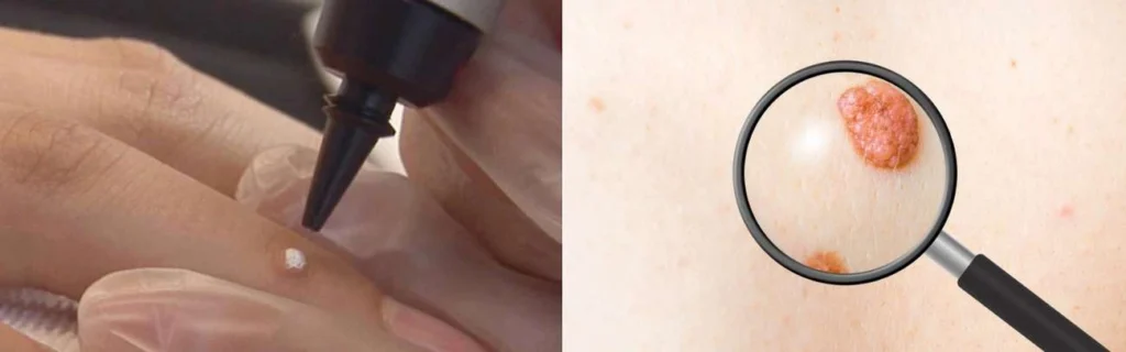 Person getting moles removed with cryopen Sidcup