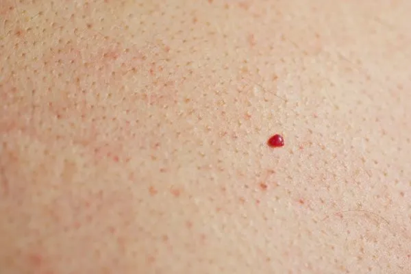 close up of a cherry angioma Sidcup