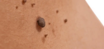 image of a skin tag Sidcup