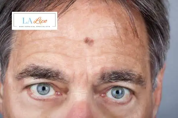 Solar Lentigo Removal Sidcup image of man with mark on his forehead