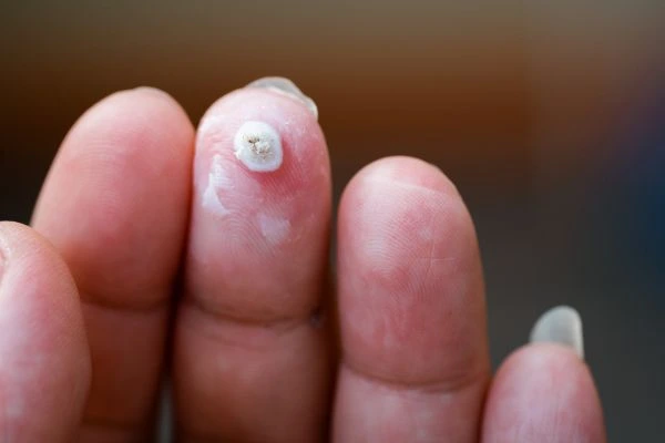 wart on person finger - cryotherapy to treat from LA LIPO Sidcup