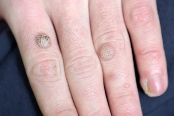 photo of warts on person hand - see wart removal Sidcup from LA LIPO
