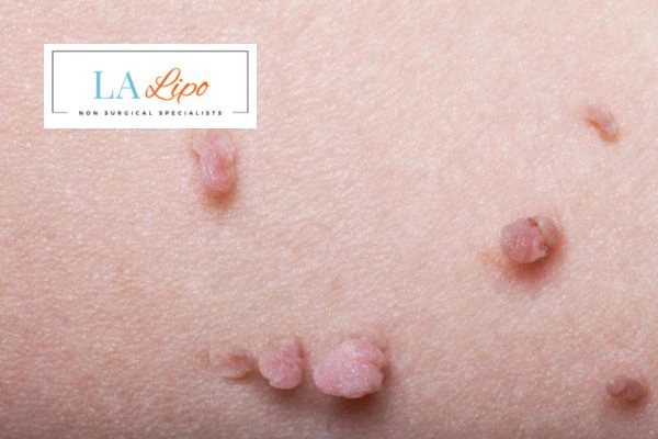 Does cryopen skin tag removal Sidcup hurt? Find out now call our team today!