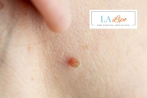 Book skin tag removal Sidcup today speak to our team now!