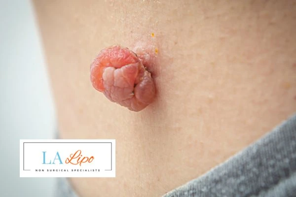 Interested in skin tag removal Sidcup? Concerned about the pain? Find out more today!