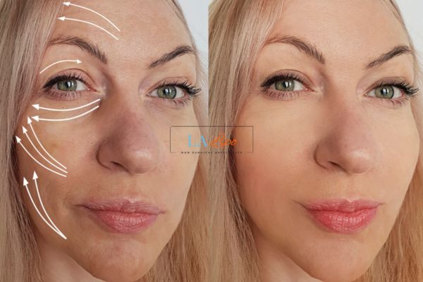Morpheus 8 results Sidcup face lift.