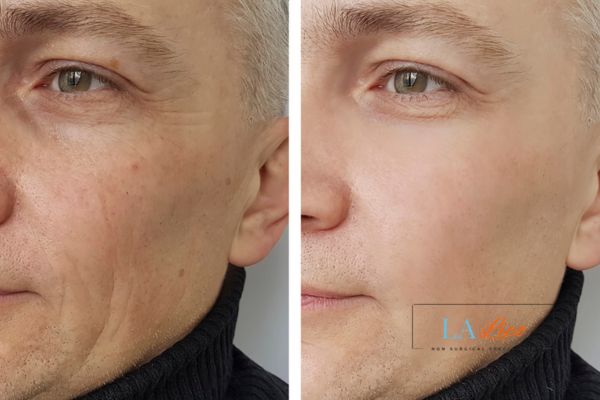 See the amazing results of Morpheus8 Treatment Sidcup!