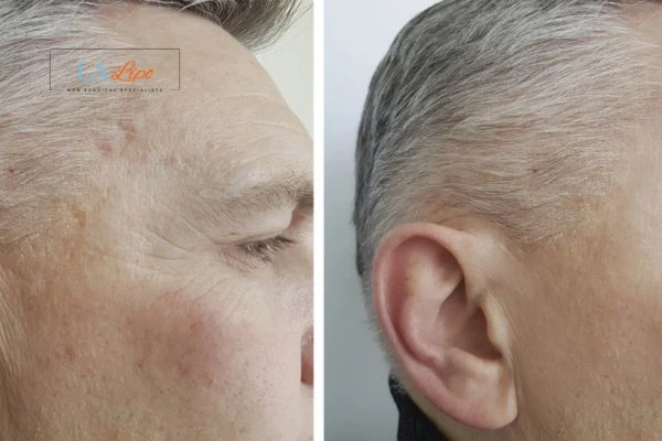 Mens Before & After Morpheus 8 Results Sidcup
