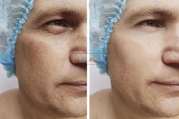 Before and after Morpheus 8 Results Sidcup