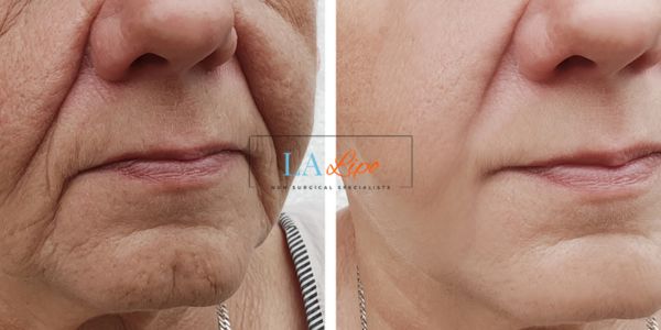 Older lady deeper wrinkle reduction - LA LIPO Morpheus 8 Results Sidcup