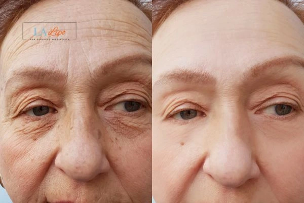 The powerful benefits of Morpheus8 Treatment Sidcup - Call Our team today!