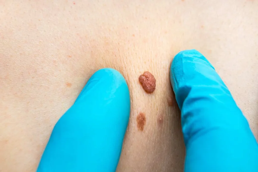 LA LIPO Cryopen Lesion Removal Prices Sidcup