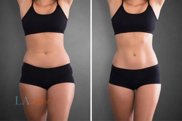 before and after results of non-surgical treatment to help a woman's body image and mental health Sidcup