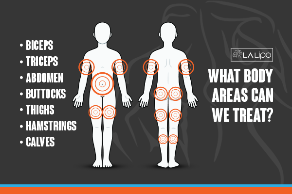 Diagram to show areas you can have LA-EMS Body Sculpting Treatment Sidcup