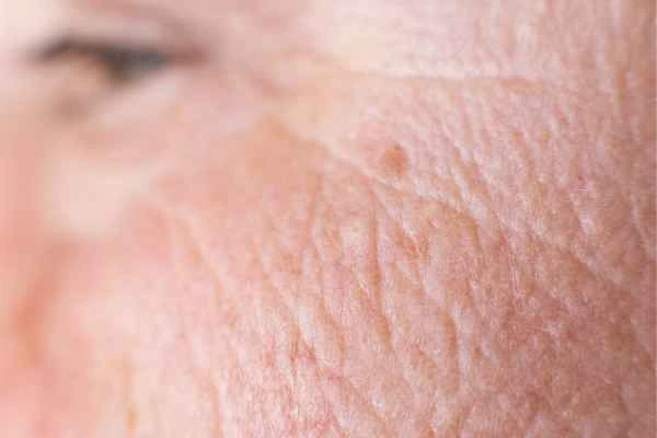 close up picture of a woman's face showing an age spot Sidcup