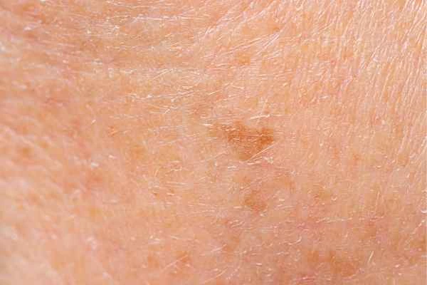 close up picture of age spots Sidcup