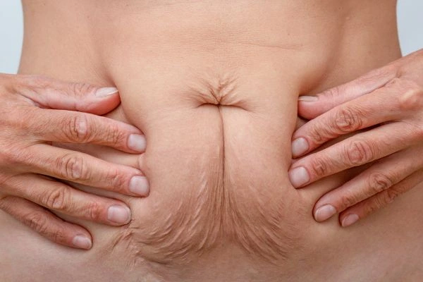 Image of a woman's stomach with loose skin - example of skin tightening Sidcup options