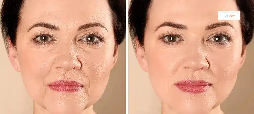 How Long Does It Take to See Results and How Long Do They Last Sidcup?