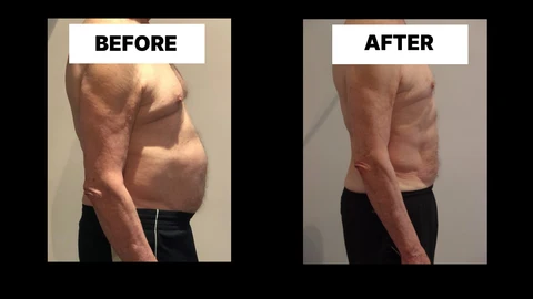 What Symptoms Can Diastasis Recti Cause in Men? Weak Core, Back Pain and Poor Posture Sidcup